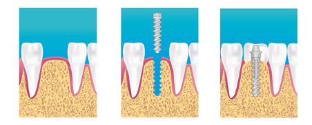 Spécialiste implant dentaire